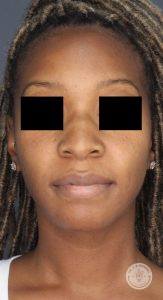 close up of african-american woman's face before liquid rhinoplasty with eyes blacked out