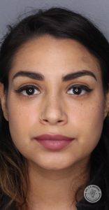 Beautiful Woman Post-Liquid Rhinoplasty- Wendel