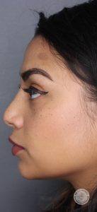 Female Profile After Dr. Wendel Liquid Rhinplasty