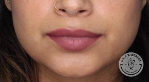 close up of woman's lips after vollure treatment