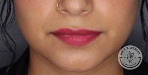 close up of woman's lips before vollure treatment