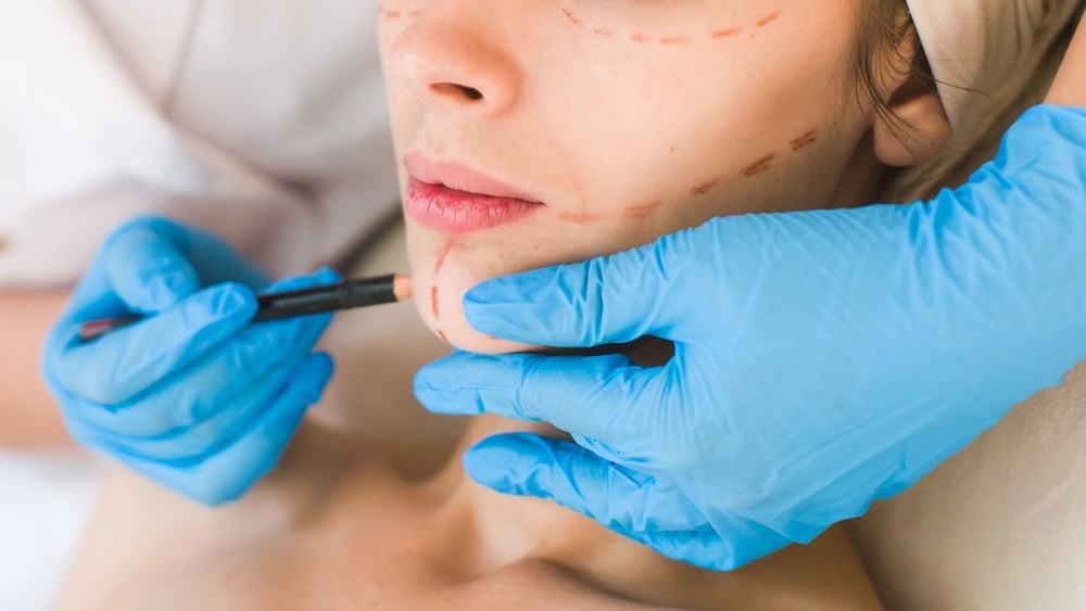 Dr. JJ Wendel Marking Woman's Face for Surgery