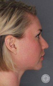 Side profile of blonde woman's face after Kybella treatment
