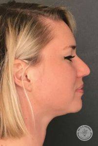 Side profile of blonde woman's face before Kybella treatment