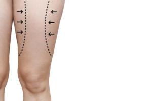 Fat Leg with Arrow and Line for Liposuction