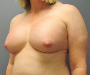 after MTF breast augmentation side view
