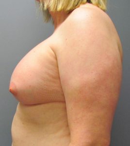 after MTF breast augmentation side view