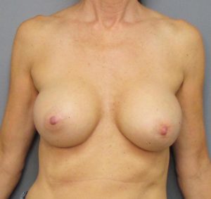 after breast implants front view