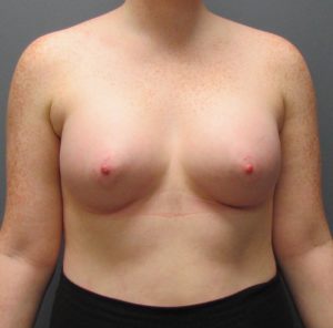 after breast implants front view