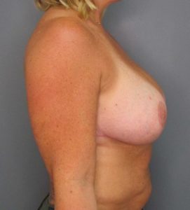 after breast implants side profile