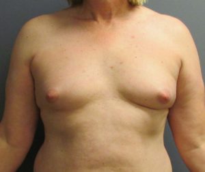 before MTF breast augmentation front view