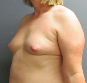 before MTF breast augmentation side view