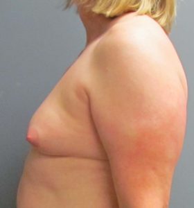 before MTF breast augmentation side view