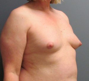 before MTF breast augmentation side view