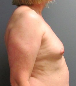 before MTF breast augmentation side view