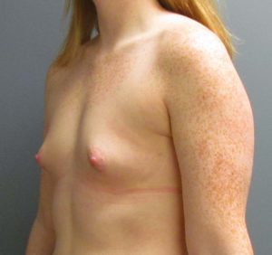 before breast implants side profile
