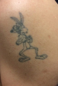 Bugs Bunny Tattoo Before Removal Dr. J. J. Wendel