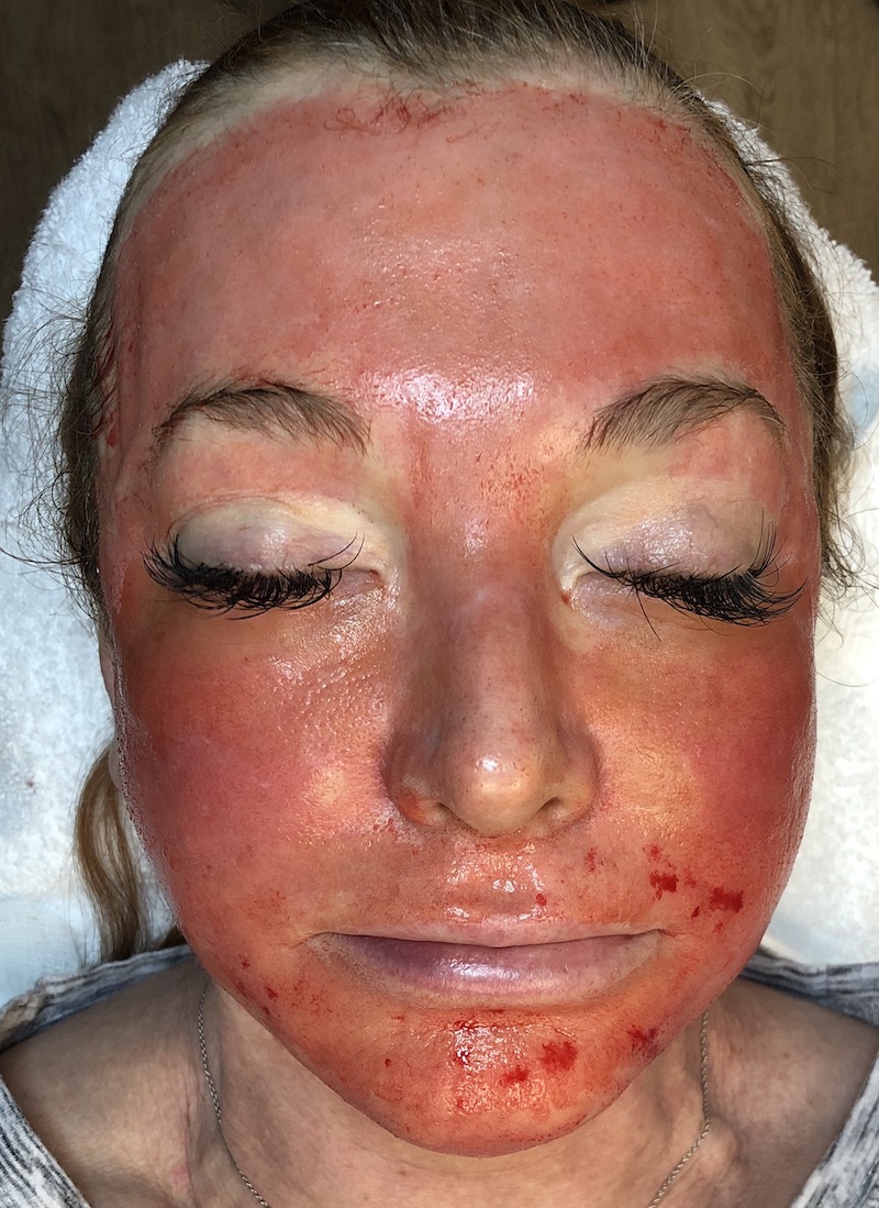 Woman Post-Collagen Boosting Laser Dr. J. J. Wendel