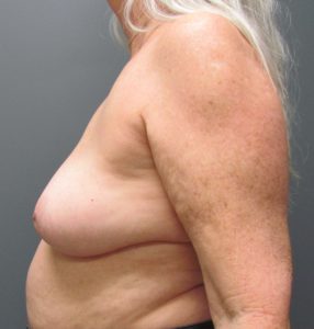 woman side profile after breast implant removal