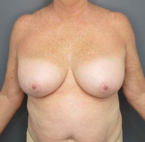 woman front of chest before breast implant removal
