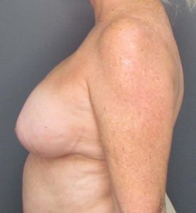 woman side profile before breast implant removal
