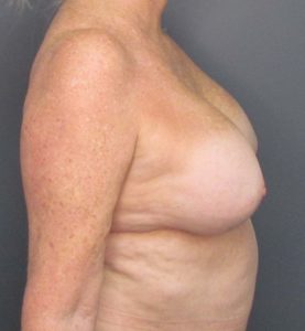before breast implant removal side profile