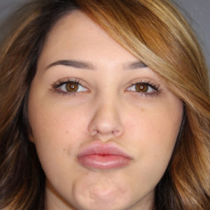 After Juvederm Lip Filler in Nashville