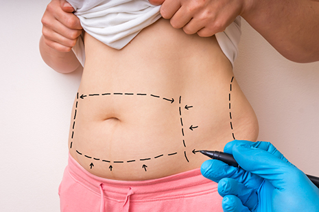 Plastic surgeon drawing body contouring lines on woman's stomach