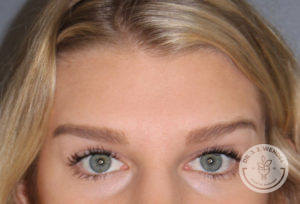 close up of caucasian woman's forehead after dysport treatment
