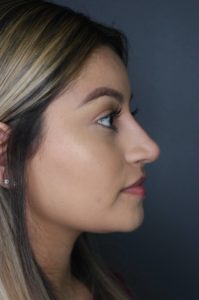 side profile of woman's face after liquid rhinoplasty