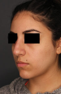 side profile of woman's face after liquid rhinoplasty with eyes blacked out