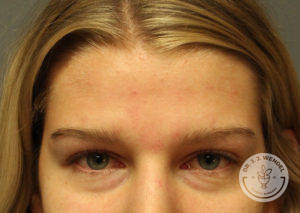 close up of caucasian woman's forehead before dysport treatment