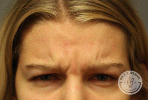close up of caucasian woman's forehead before dysport treatment