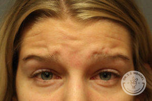 close up of caucasian woman's forehead before dysport treatment