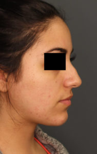 Before a liquid rhinoplasty procedure image 2