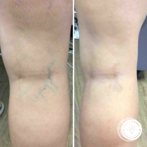 Before and after sclerotherapy in Nashville, TN