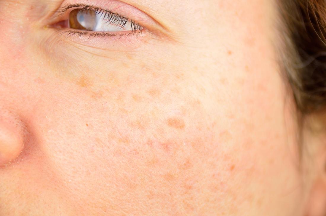 Sun damage on woman's cheek