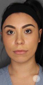 Headshot of a woman before getting a voluma treatment