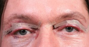 Closeup of a man who underwent an eyelid lift