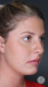 Side profile of woman's face after fillers