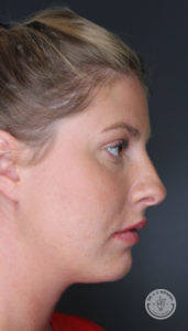 Side profile of woman's face after fillers