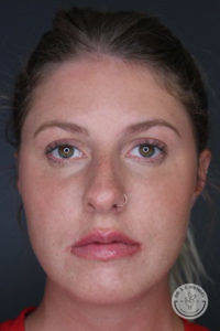 forward facing woman after fillers