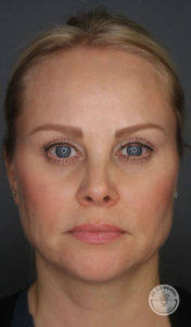close up of caucasian woman's face front view after kybella