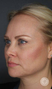 close up of caucasian woman's face side view after kybella