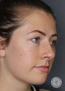 side profile of woman after restylane
