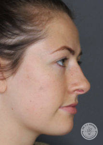 Side profile of woman after restylane