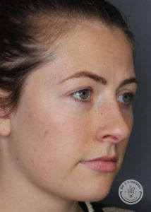 Side profile of woman after restylane