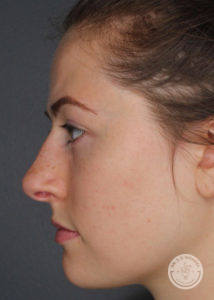 side profile of woman after restylane