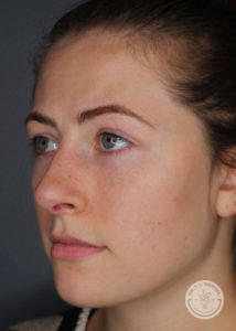 Side profile of woman after restylane