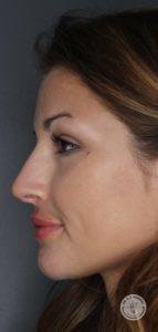 side profile of woman after voluma